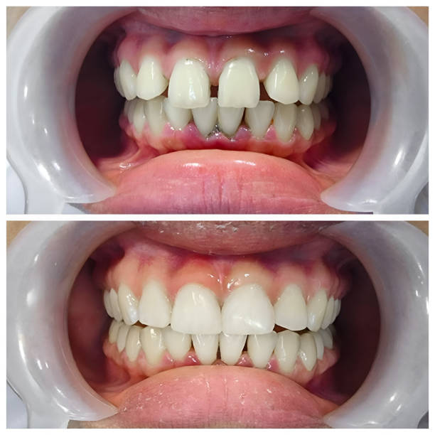 Full Mouth Reconstruction in Eminence, KY